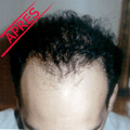 greffe cheveux