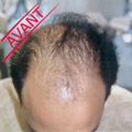 greffes cheveux